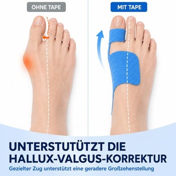Páska na Hallux Valgus, korekčná páska na Hallux Valgus, kineziologická páska