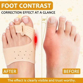 Korekcia Hallux valgus, rozťahovače prstov na hallux valgus, balenie 3 párov, mäkký materiál, pohodlné