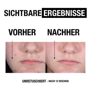 Neutrogena Anti-Blemish+ exfoliační čisticí gel, 200 ml (1 balení)