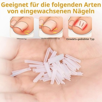 Náplasti na korekciu zarastených nechtov Beugo, sada 167 kusov, sada 167*náplastí na korekciu zarastených