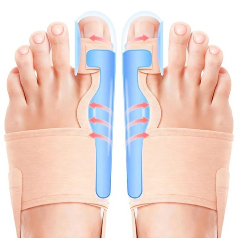 2x korekční dlaha na Hallux Valgus - narovnání prstů ve dne i v noci, bandáž na Hallux Valgus pro